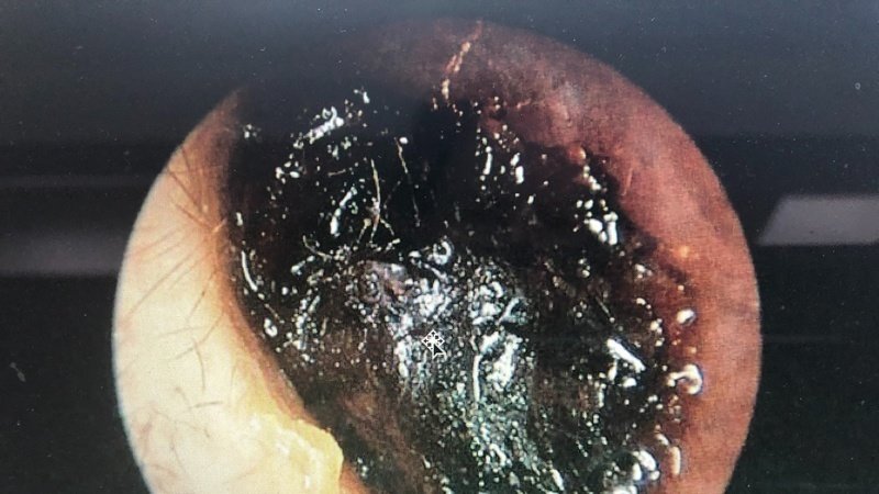 ear wax removal